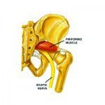 Piriformis Syndrome – A Real Pain in the Butt